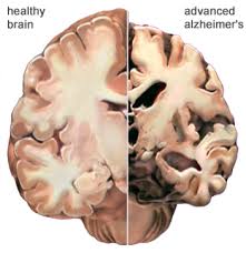Alzheimer’s  Disease and Dementia